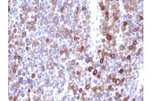 Formalin-fixed, paraffin-embedded human Melanoma stained with Moesin Mouse Monoclonal Antibody (MSN/491). (Moesin antibody)
