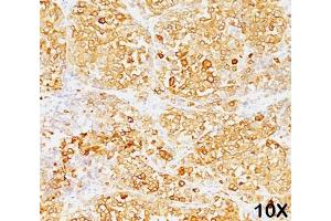 Formalin/paraffin human melanoma stained with MART-1 / Melan-A antibody (M2-9E3). (MLANA antibody)