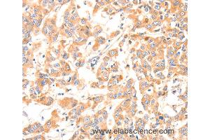 Immunohistochemistry of Human gastric cancer using F13A1 Polyclonal Antibody at dilution of 1:80 (F13A1 antibody)