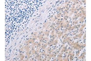 The image on the left is immunohistochemistry of paraffin-embedded Human liver cancer tissue using ABIN7191852(PFN2 Antibody) at dilution 1/30, on the right is treated with synthetic peptide. (PFN2 antibody)