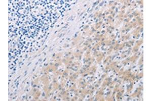 The image on the left is immunohistochemistry of paraffin-embedded Human liver cancer tissue using ABIN7191852(PFN2 Antibody) at dilution 1/30, on the right is treated with synthetic peptide. (PFN2 antibody)