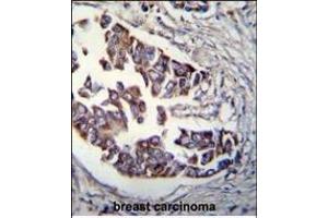 Rad9 Antibody  (ABIN655465 and ABIN2844992) immunohistochemistry analysis in formalin fixed and paraffin embedded human breast carcinoma followed by peroxidase conjugation of the secondary antibody and DAB staining. (RAD9A antibody  (AA 365-391))
