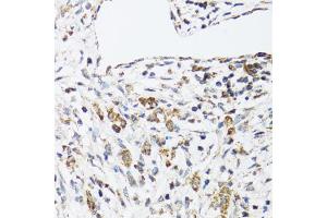 Immunohistochemistry of paraffin-embedded human uterine cancer using DHRS2 antibody (ABIN5973846) at dilution of 1/100 (40x lens). (DHRS2 antibody)