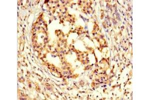 Immunohistochemistry of paraffin-embedded human pancreatic cancer using ABIN7164529 at dilution of 1:100