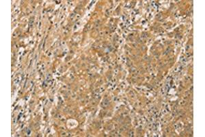 The image on the left is immunohistochemistry of paraffin-embedded Human gastic cancer tissue using ABIN7131118(SNAP91 Antibody) at dilution 1/20, on the right is treated with fusion protein. (SNAP91 antibody)