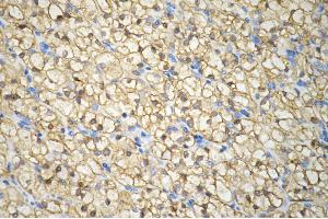 Immunohistochemistry was performed on paraffin-embedded human renal carcinoma using PPM1G antibody (ABIN7800035), 1:200). (Recombinant PPM1G antibody)