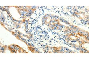 Immunohistochemistry of paraffin-embedded Human gasrtic cancer tissue using TRPA1 Polyclonal Antibody at dilution 1:60 (TRPA1 antibody)