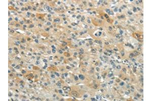 The image on the left is immunohistochemistry of paraffin-embedded Human liver cancer tissue using ABIN7193074(XKR3 Antibody) at dilution 1/20, on the right is treated with synthetic peptide. (XKR3 antibody)