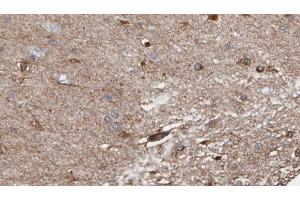 ABIN6278520 at 1/100 staining Human brain cancer tissue by IHC-P. (SGCB antibody  (N-Term))