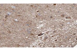 ABIN6278520 at 1/100 staining Human brain cancer tissue by IHC-P.