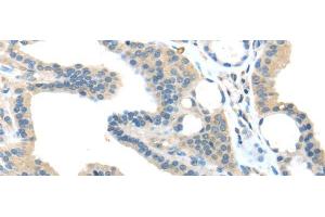 Immunohistochemistry of paraffin-embedded Human thyroid cancer tissue using VPS36 Polyclonal Antibody at dilution 1:40 (VPS36 antibody)