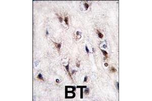 Formalin-fixed and paraffin-embedded human brain tissue reacted with NURR1 (NR4A2) antibody (N-term) (ABIN390383 and ABIN2840784) , which was peroxidase-conjugated to the secondary antibody, followed by DAB staining. (NR4A2 antibody  (N-Term))