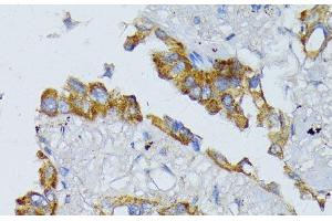 Immunohistochemistry of paraffin-embedded Human lung cancer using ACADL Polyclonal Antibody at dilution of 1:100 (40x lens). (ACADL antibody)
