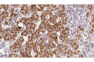 ABIN6278960 at 1/100 staining Human liver cancer tissue by IHC-P. (XCR1 antibody)
