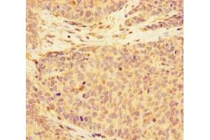 Immunohistochemistry of paraffin-embedded human ovarian cancer using ABIN7146155 at dilution of 1:100 (C2 Calcium-Dependent Domain-Containing Protein 6 (C2CD6) (AA 401-623) antibody)