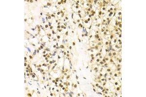 Immunohistochemistry of paraffin-embedded human kidney cancer using BAG1 antibody at dilution of 1:100 (x400 lens). (BAG1 antibody)