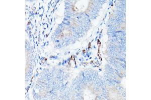 Immunohistochemistry of paraffin-embedded human colon carcinoma using CDH5 Rabbit pAb (ABIN6134029, ABIN6138297, ABIN6138298 and ABIN6216033) at dilution of 1:150 (40x lens). (Cadherin 5 antibody  (AA 650-750))