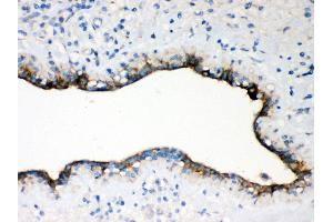 Anti- Occludin antibody,IHC(P) IHC(P): Human Mammary Cancer Tissue (Occludin antibody  (AA 373-522))