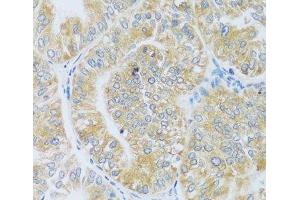 Immunohistochemistry of paraffin-embedded Human uterine cancer using ASB4 Polyclonal Antibody at dilution of 1:100 (40x lens). (ASB4 antibody)