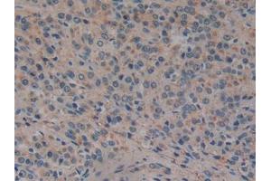 DAB staining on IHC-P; Samples: Human Prostate cancer Tissue (GP2 antibody  (AA 307-512))