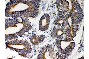 Anti- Hsp60 Picoband antibody, IHC(P) IHC(P): Human Intestinal Cancer Tissue