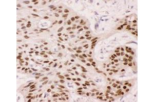 IHC-P: p63 antibody testing of human oesophagus squama cancer tissue (TCP1 alpha/CCTA antibody  (AA 311-680))