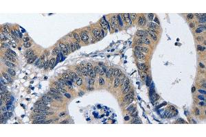 Immunohistochemistry of paraffin-embedded Human colon cancer using NFKBID Polyclonal Antibody at dilution of 1:40