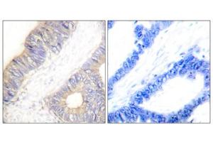 Immunohistochemistry analysis of paraffin-embedded human colon carcinoma tissue using Stefin A antibody. (CSTA antibody  (Internal Region))