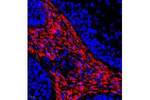Immunofluorescence of paraffin embedded human laryngocarcinoma using CRMP3 (ABIN7073734) at dilution of 1:650 (400x lens) (DPYSL4 antibody)