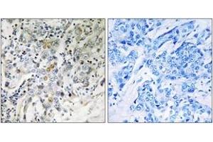 Immunohistochemistry analysis of paraffin-embedded human breast carcinoma tissue, using ELL2 Antibody. (ELL2 antibody  (AA 448-497))