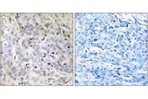Immunohistochemistry analysis of paraffin-embedded human breast carcinoma tissue, using PDIK1L Antibody. (PDIK1L antibody  (AA 101-150))
