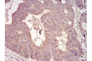 Immunohistochemical analysis of paraffin-embedded rectum cancer tissues using MuRF1 mouse mAb with DAB staining. (TRIM63 antibody  (AA 293-304))