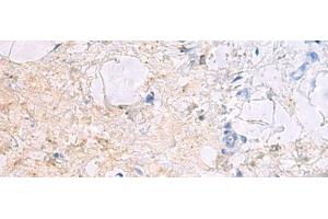 Immunohistochemistry of paraffin-embedded Human gastric cancer tissue using DPCD Polyclonal Antibody at dilution of 1:50(x200) (DPCD antibody)