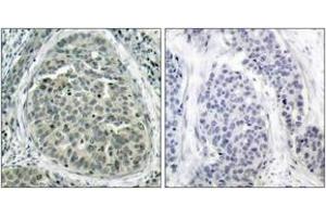 Immunohistochemistry analysis of paraffin-embedded human breast carcinoma, using Catenin-beta (Phospho-Ser37) Antibody. (beta Catenin antibody  (pSer37))