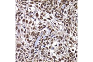 Immunohistochemistry of paraffin-embedded human well-differentiated squamous skin carcinoma using DNAJB6 antibody at dilution of 1:100 (x400 lens).