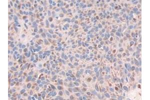 Detection of ECH1 in Human Skin cancer Tissue using Polyclonal Antibody to Enoyl Coenzyme A Hydratase 1, Peroxisomal (ECH1) (ECH1 antibody  (AA 1-328))