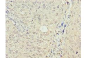 Immunohistochemistry of paraffin-embedded human lung cancer using ABIN7160268 at dilution of 1: 100 (RAE1 antibody  (AA 1-368))