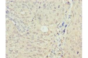 Immunohistochemistry of paraffin-embedded human lung cancer using ABIN7160268 at dilution of 1: 100 (RAE1 antibody  (AA 1-368))
