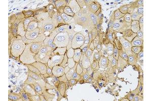 Immunohistochemistry of paraffin-embedded human breast cancer using PDE4D antibody (ABIN5970821) at dilution of 1/100 (40x lens). (PDE4D antibody)