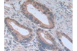 Detection of NOTCH4 in Human Stomach Cancer Tissue using Polyclonal Antibody to Notch Homolog 4 (NOTCH4) (NOTCH4 antibody  (AA 1715-2001))