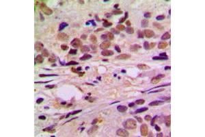 Immunohistochemical analysis of Cyclin L1 staining in human breast cancer formalin fixed paraffin embedded tissue section. (Cyclin L1 antibody  (C-Term))
