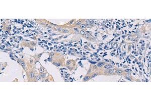 Immunohistochemistry of paraffin-embedded Human esophagus cancer tissue using GALR3 Polyclonal Antibody at dilution of 1:50(x200)