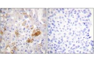 Immunohistochemistry analysis of paraffin-embedded human breast carcinoma, using Integrin beta1 (Phospho-Thr788) Antibody. (ITGB1 antibody  (pThr788))