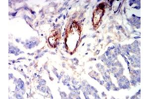 Immunohistochemical analysis of paraffin-embedded ovarian cancer tissues using CD363 mouse mAb with DAB staining. (S1PR1 antibody)