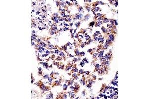 (ABIN6242390 and ABIN6578681) staining Hsp60 in human lung adenocarcinoma tissue sections by Immunohistochemistry (IHC-P - paraformaldehyde-fixed, paraffin-embedded sections). (HSPD1 antibody  (AA 396-430))