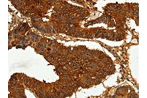 The image on the left is immunohistochemistry of paraffin-embedded Human colon cancer tissue using ABIN7128894(CEACAM21 Antibody) at dilution 1/60, on the right is treated with fusion protein. (CEACAM21 antibody)