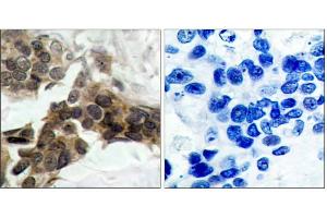 Immunohistochemical analysis of paraffin-embedded human breast carcinoma tissue, using IκB-α (phospho-Ser32/Ser36) antibody (E011152) . (NFKBIA antibody  (pSer32, pSer36))