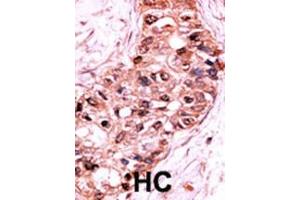 Formalin-fixed and paraffin-embedded human cancer tissue reacted with the primary antibody, which was peroxidase-conjugated to the secondary antibody, followed by AEC staining. (Caspase 9 antibody  (pSer196))