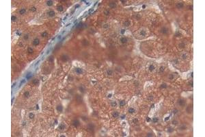 Detection of PYGL in Human Liver cancer Tissue using Polyclonal Antibody to Glycogen Phosphorylase, Liver (PYGL) (PYGL antibody  (AA 370-538))