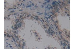 Detection of VIL in Human Prostate Tissue using Polyclonal Antibody to Villin (VIL) (Villin 1 antibody  (AA 1-320))